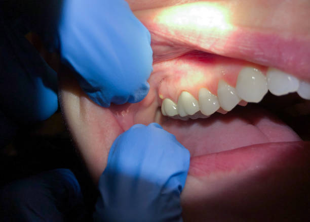 Best Chipped Tooth Repair Near Me  in Thornton, IL